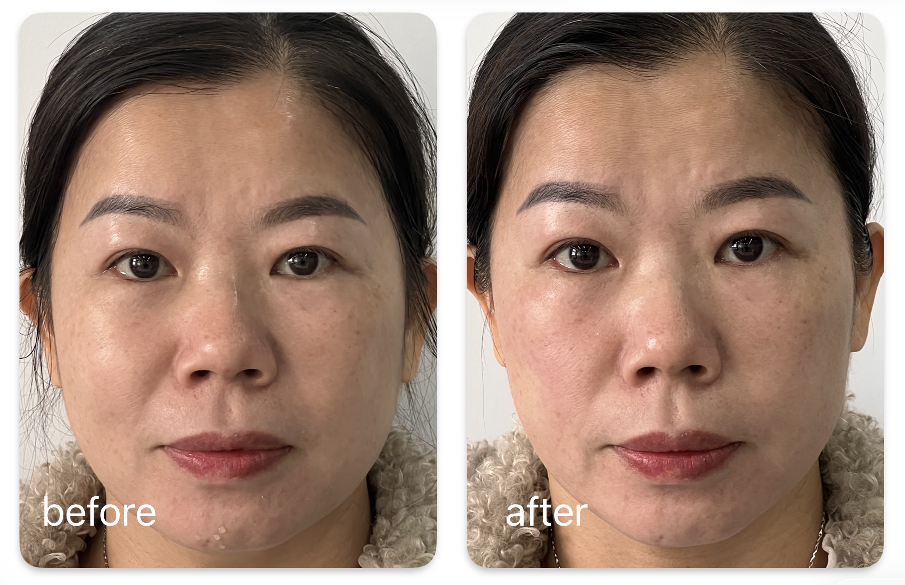 Real KOLIFU before and after treatment result