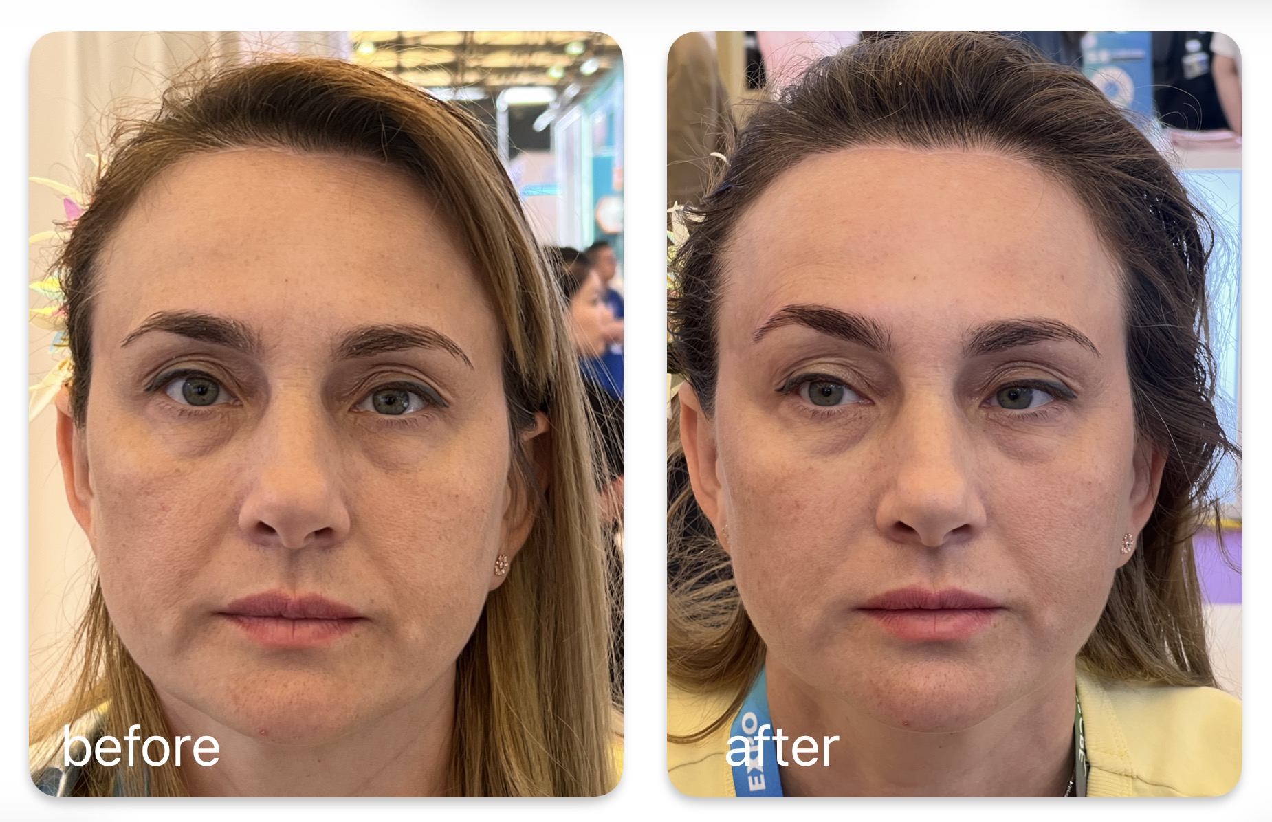 CPT TIME PRINCESS full-face lifting before and after