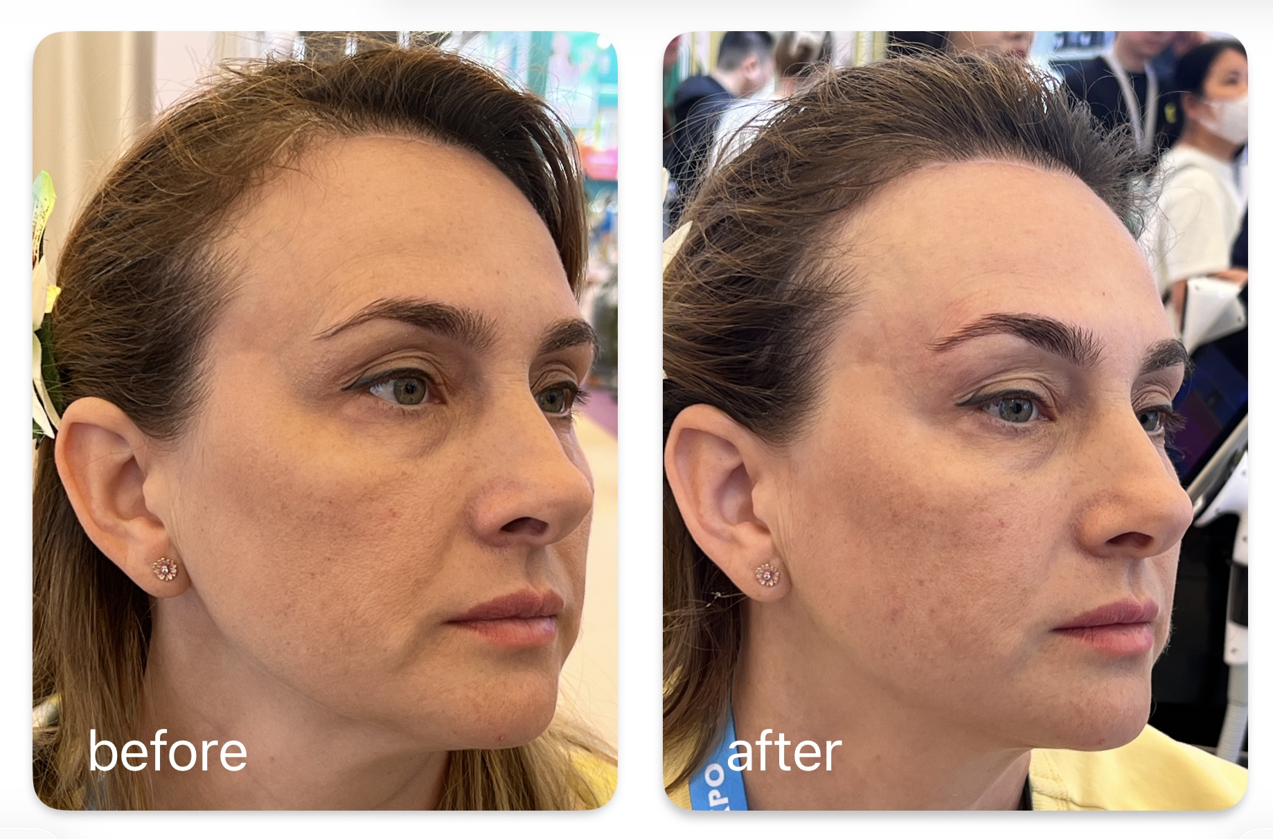 CPT TIME PRINCESS jawline contouring before and after